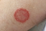 US logs first case of rare, sexually transmitted form of ringworm; details here
